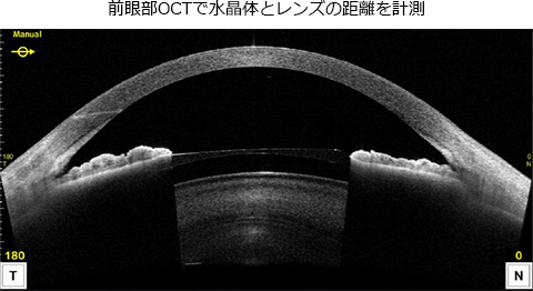 前眼部OCTで水晶体とレンズの距離を計測