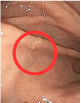 内視鏡で、胃粘膜に刺⼊しているアニサキス発⾒。